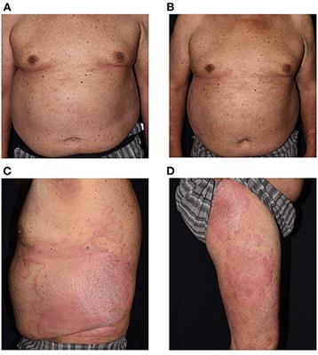 Exacerbation of Psoriasis Following COVID-19 Vaccination: Report From a Single Center